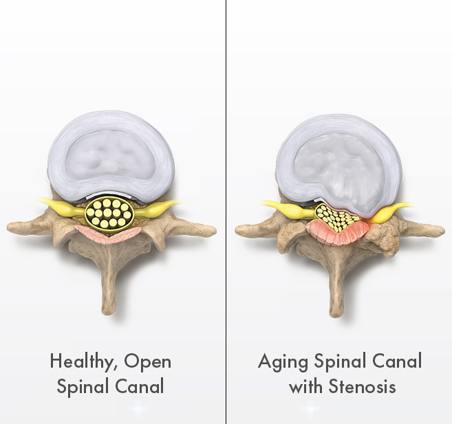 Graphic - Healthy vs. aging spinal canal with lumbar spinal stenosis