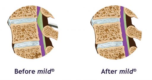 Before and after images showing the improvement in lumbar spinal stenosis after patients have undergone the mild® procedure