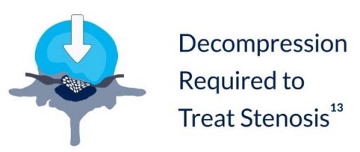 Decompression required to treat stenosis