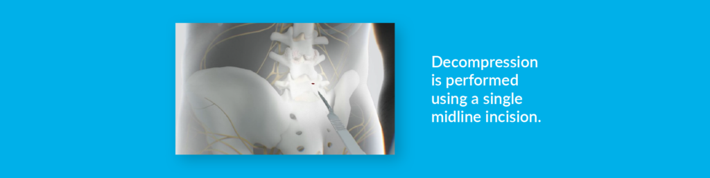 Image showing spinal decompression performed with a single midline incision