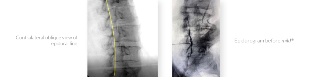 X-Rays of a spine suffering from lumbar spinal stenosis