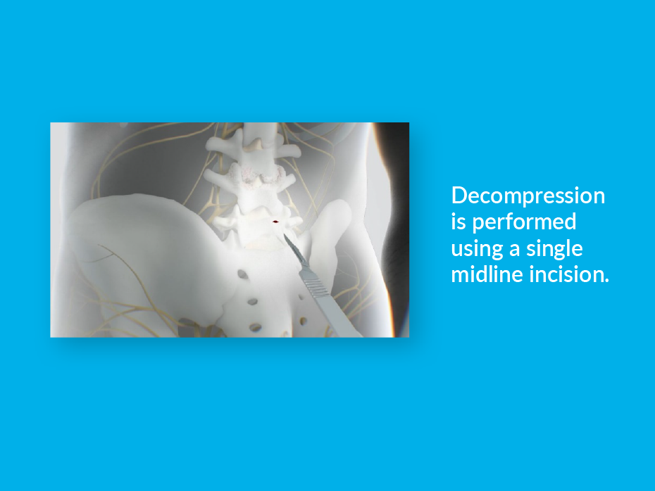 Image showing spinal decompression performed with a single midline incision