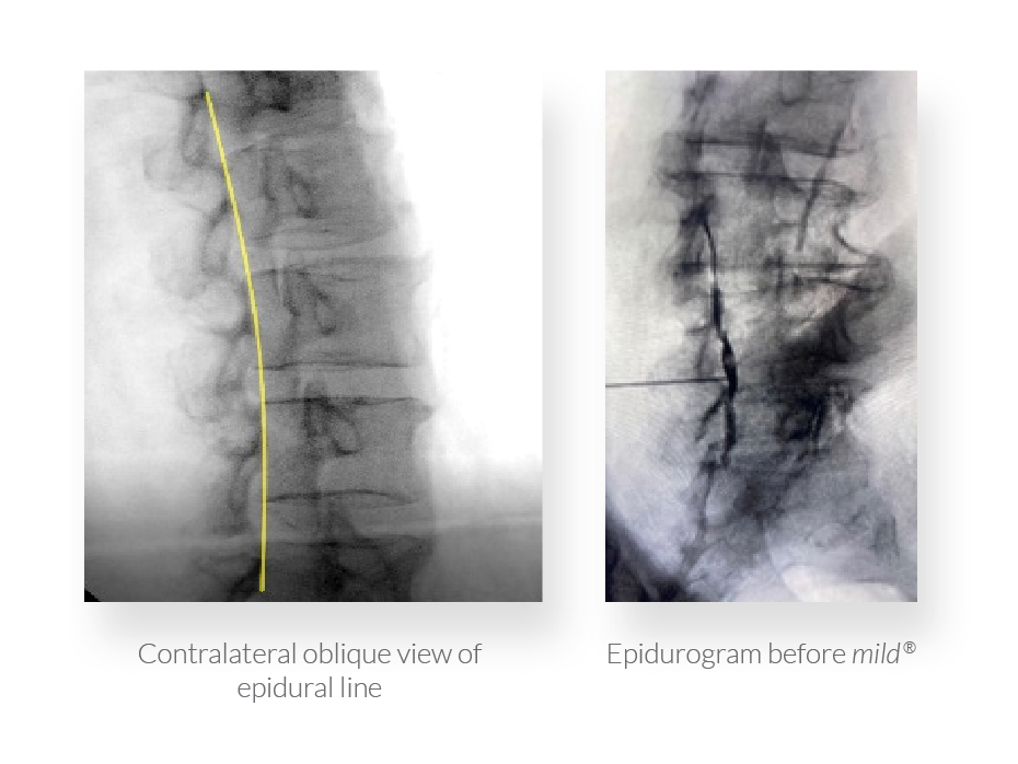 X-Rays of a spine suffering from lumbar spinal stenosis