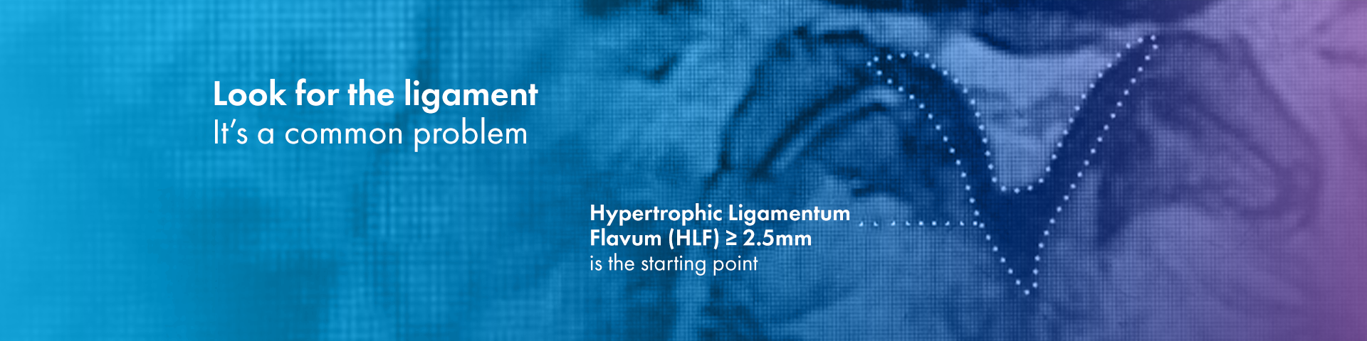 "Look for the ligament. It's a common problem. Hypertrophic Ligamentum Flavum (HLF) >= 2.5mm is the starting point."