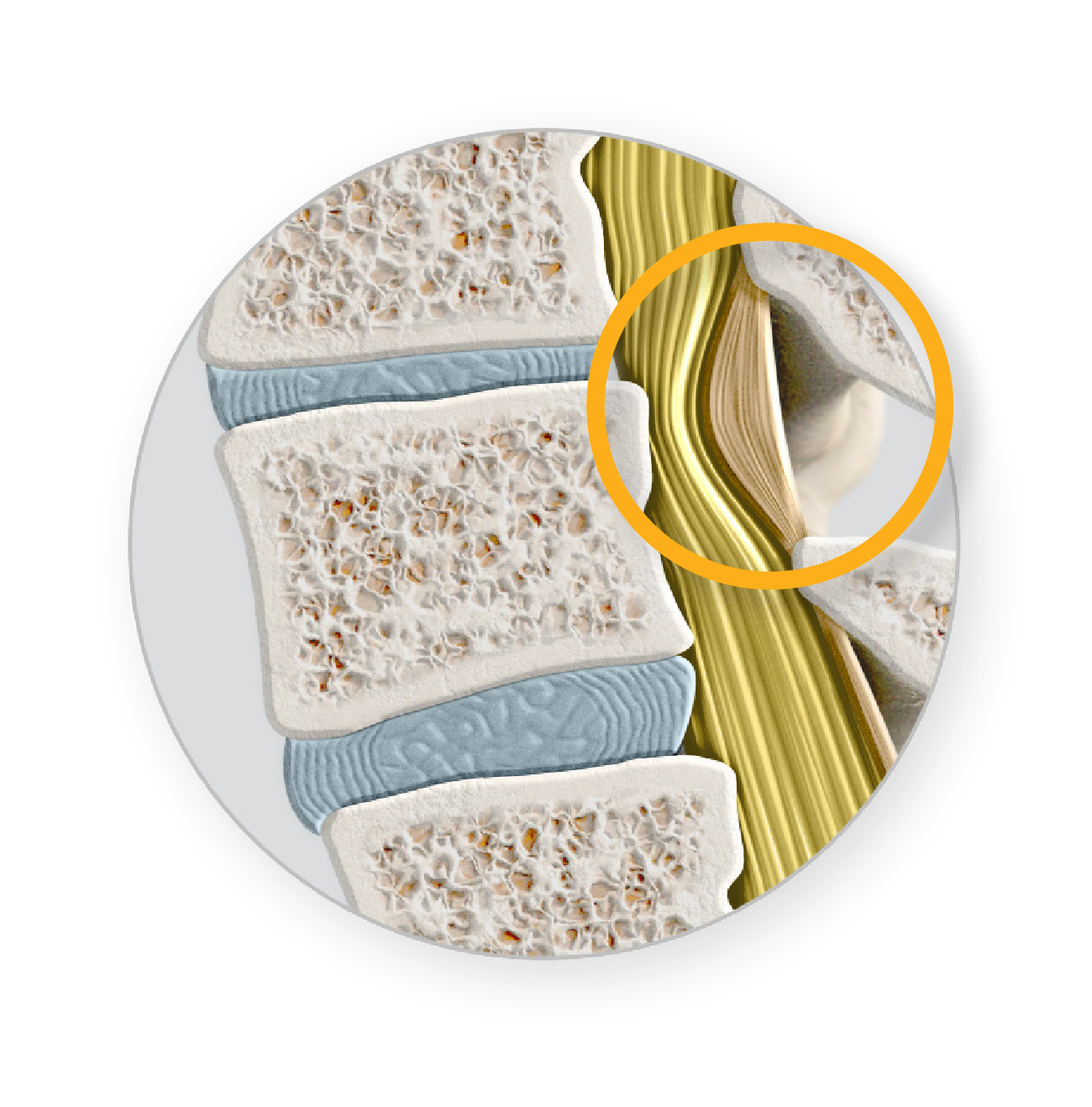 Image showing spinal compression before mild procedure