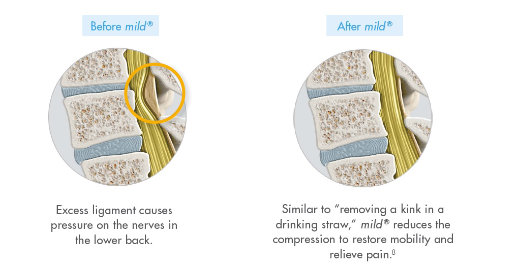 Photos showing before and after images of a patient treated with the mild® Procedure and suffering from lumbar spinal stenosis