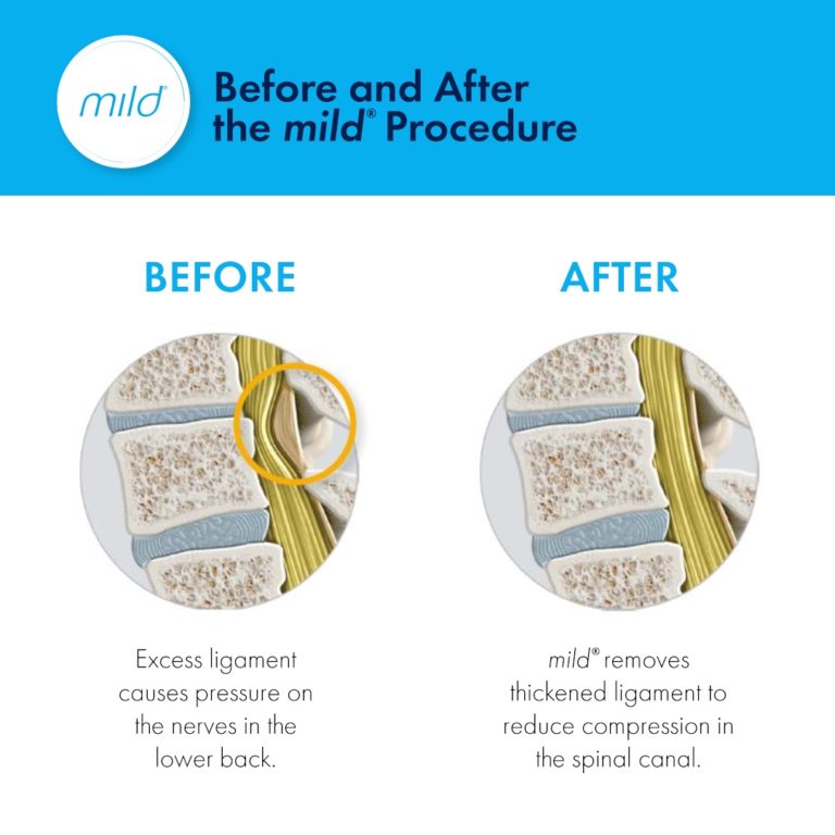 Before and After the mild® Procedure graphic for social media