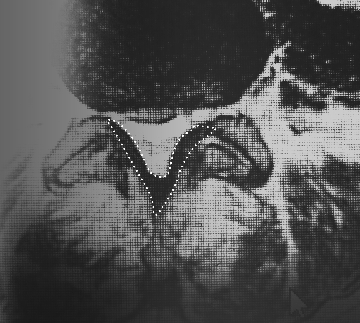 image showing ligamentum flavum in patient suffering from lumbar spinal stenosis