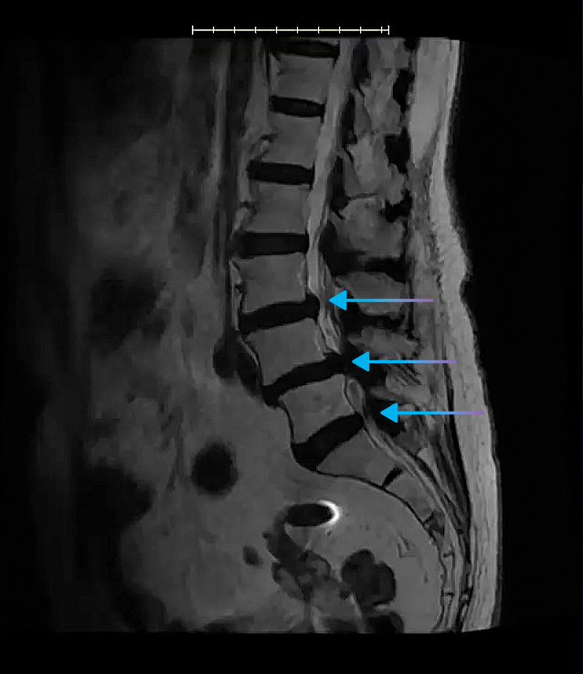 sagittal view showing where the spinal canal narrows where the central canal is stenosed