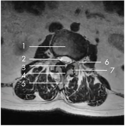 Image showing Vertebral Body