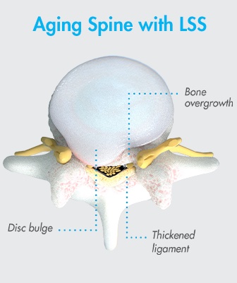 Illustration of an aging spine of a person suffering from lumbar spinal stenosis