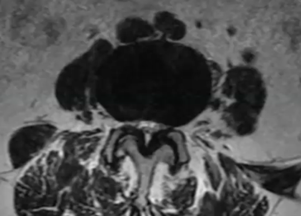 image showing hypertrophic ligamentum flavum compressing the nerves