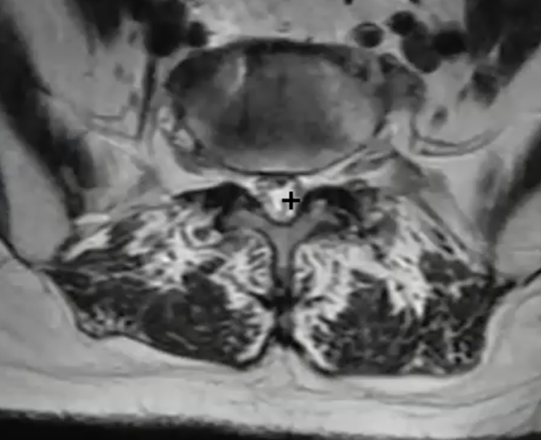 image showing comparison of the healthy central canal