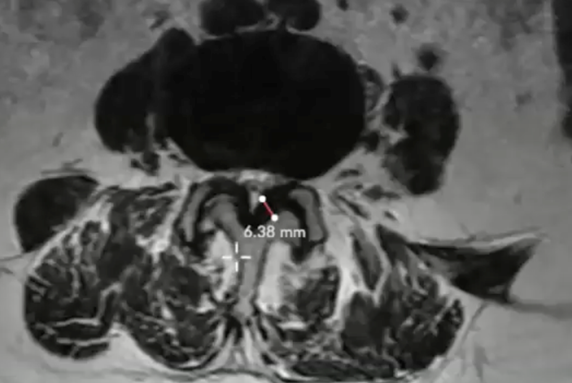 image showing an HLF measurement of 6.38 mm