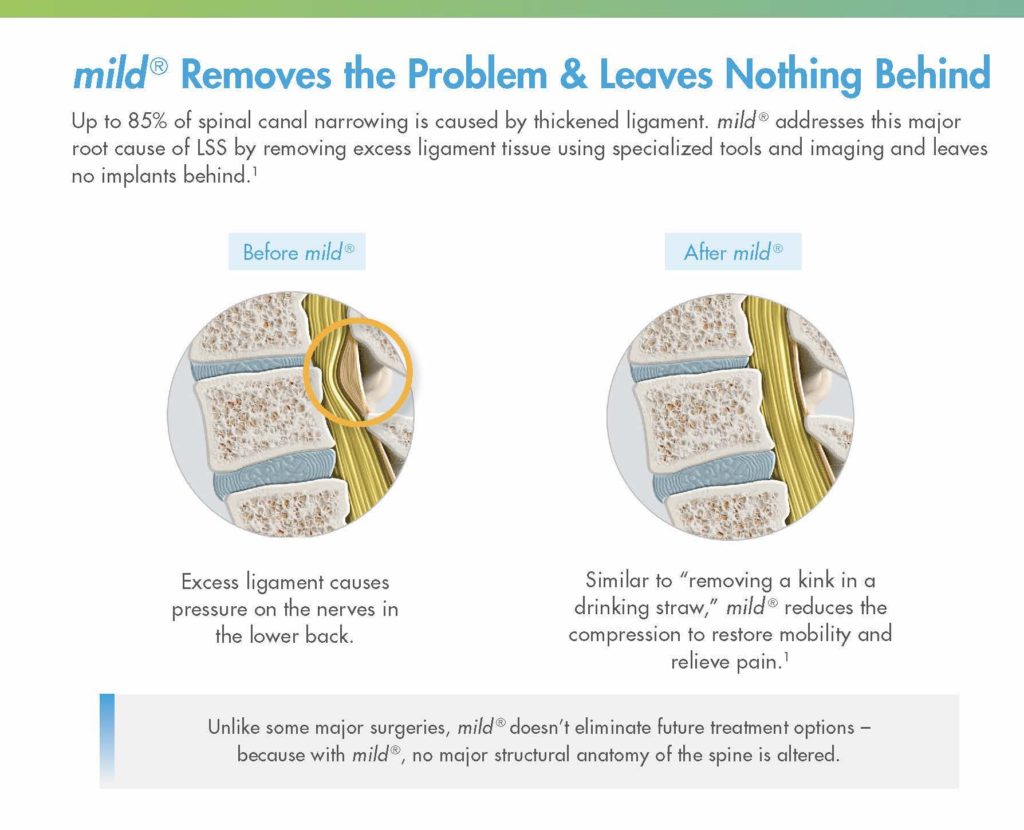 Infographic showing an illustrations of spinal compression before and after the mild® procedure 