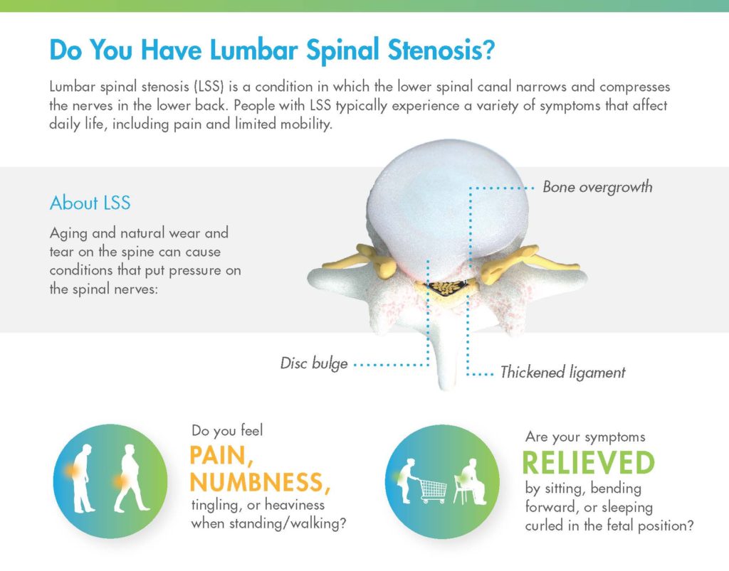 Infographic showing the symptoms of lumbar spinal stenosis (LSS)