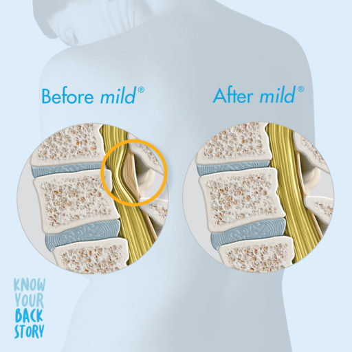 Woman's back. Text, Before mild, After mild. First image spine is impacted by the thickened ligament. Second image, spine is normal and not under pressure.