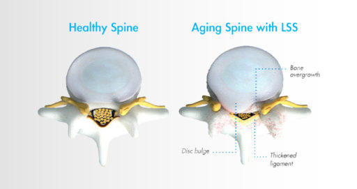 Two spinal vertebrae next to each other. Left shows a healthy spine. The right shows an aging spine with LSS (lumbar spinal stenosis). It includes a disc bulge, a thickened ligament, and bone overgrowth.