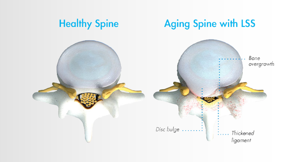 Dark Side of Repeat Epidural Steroid Injections for Spinal Stenosis