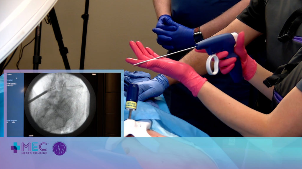 Demonstrating the tissue sculptor. This photo shows Dr. Kroopf demonstrating The mild Procedure to participating physicians via a virtual reality headset. The livestream included a live X-ray monitor.