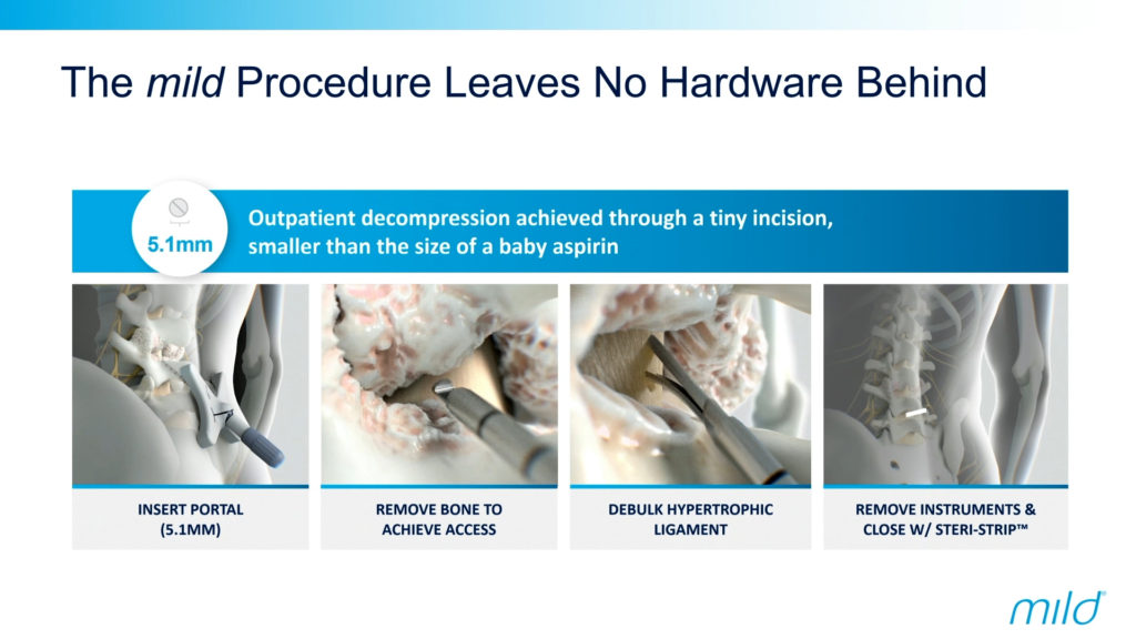 Short infographic titled: The mild Procedure leaves no hardware behind. Text in the image says "Outpatient decompression achieved through a tiny incision, smaller than the size of a baby aspirin." 4 images follow with text that says: "Insert Portal (5.1MM)," "Remove bone to achieve access," "Debulk hypertrophic ligament," and "Remove instruments & close w/steri-strip".