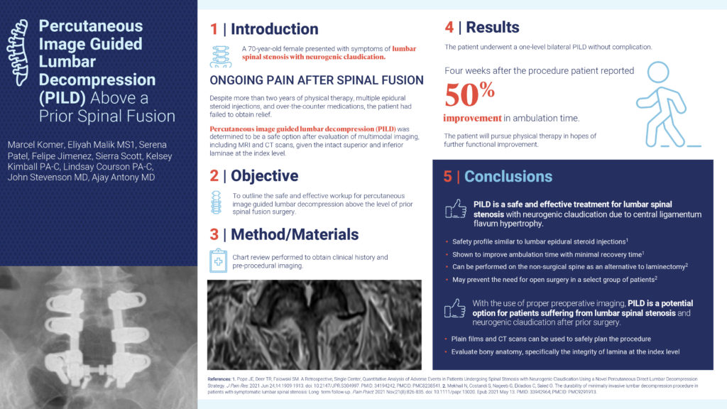Percutaneous image guided lumbar decompression (PILD) was determined to be a safe option after evaluation of multimodal imaging, including MRI and CT scans, given the intact superior and interior laminae at the index level. Infographic: Percutaneous Image Guided Lumbar Decompression (PILD) above a prior spinal fusion